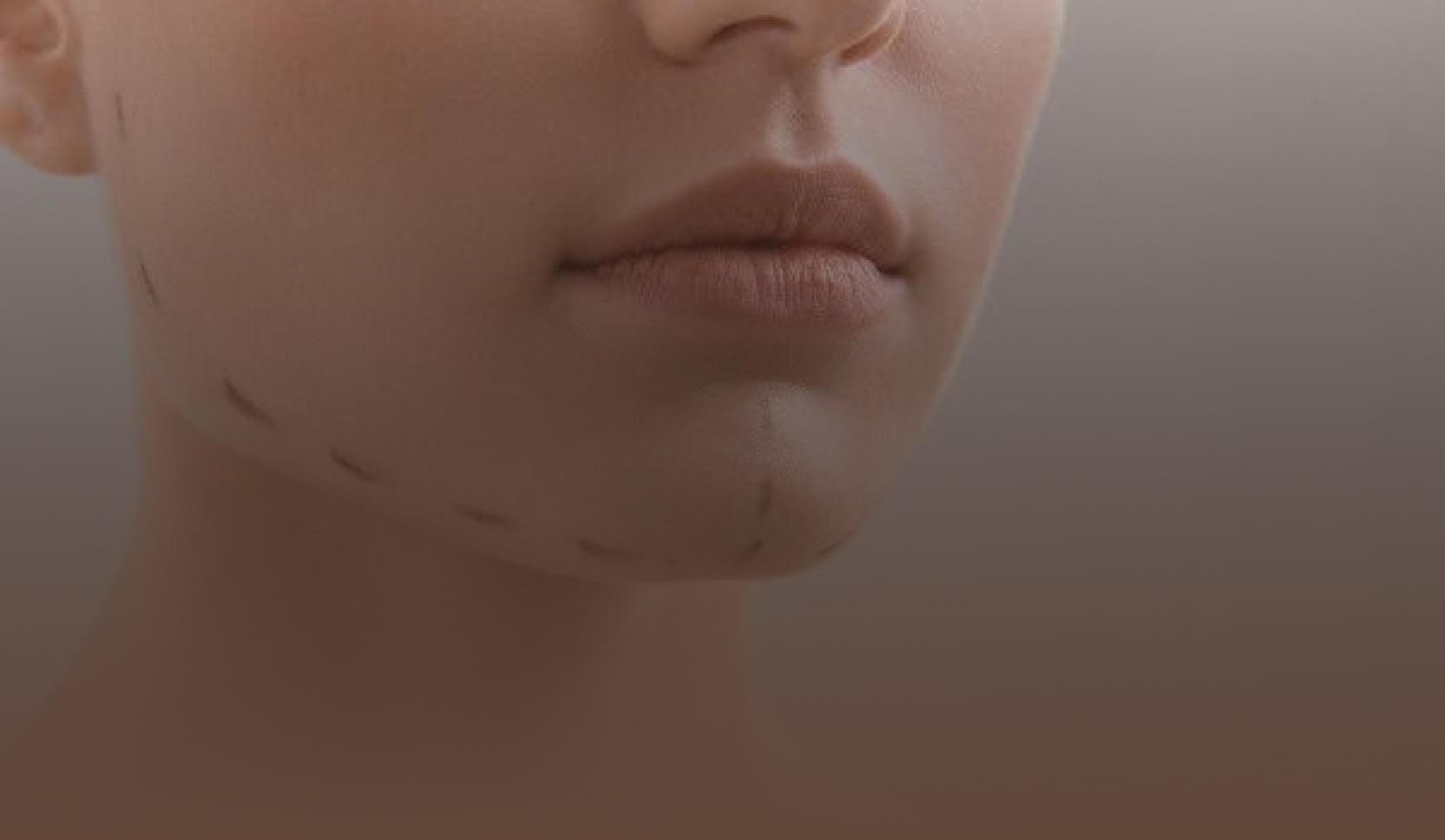 Preenchimento de mento (queixo) e maxilar em Brusque